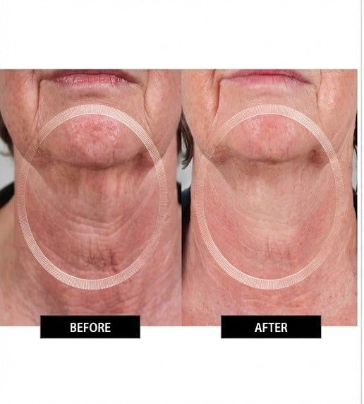Numiere EMS Neck & Face Lift